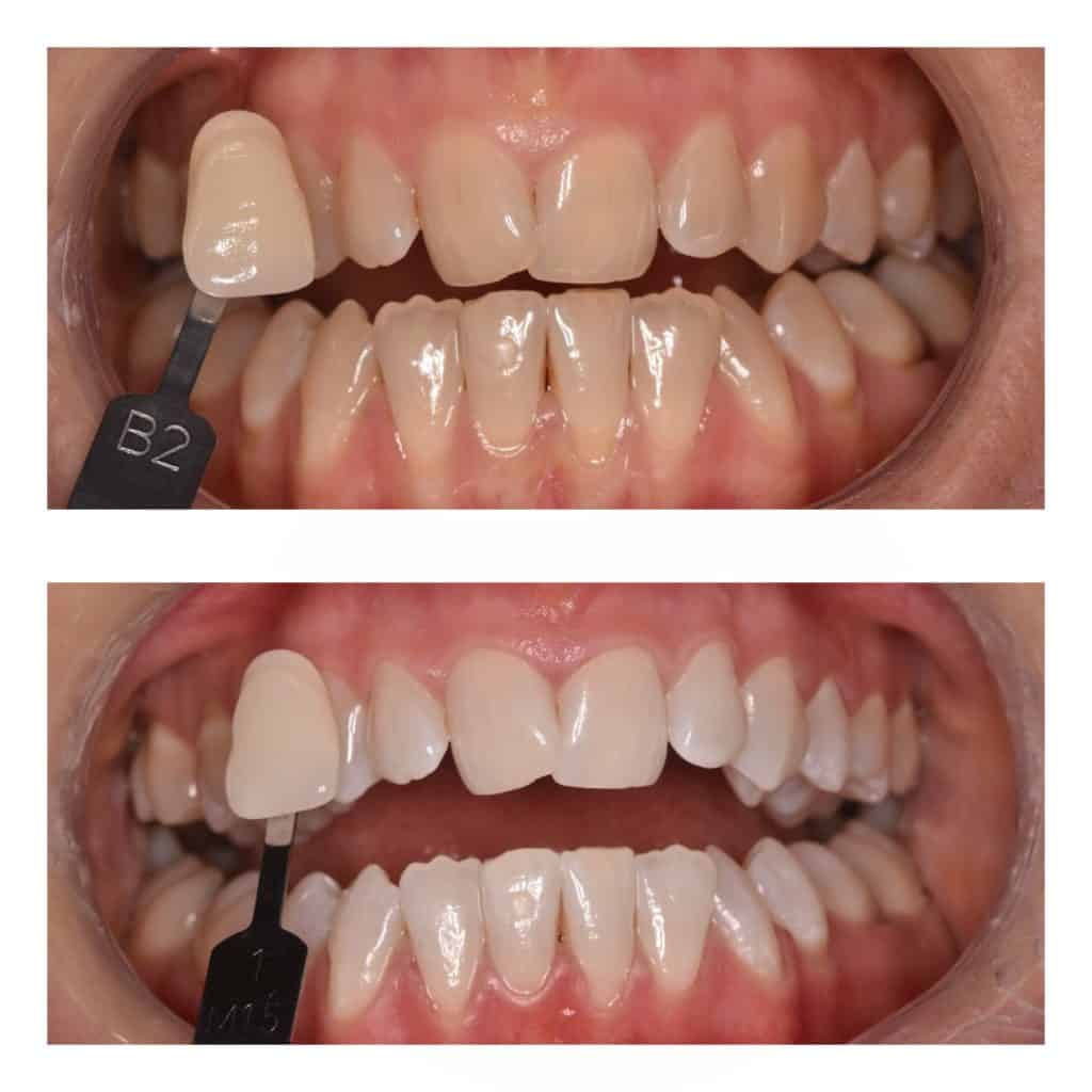 Teeth Whitening Dental Treatment