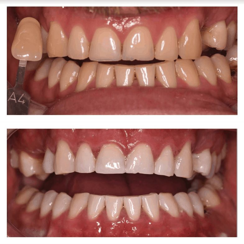 Teeth Whitening Dental Treatment