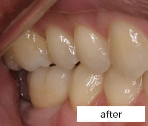 after dental implant treatments