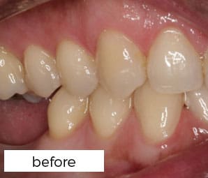 before dental implant treatment