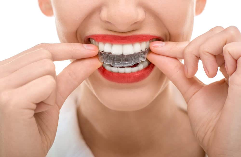 Invisalign Preston